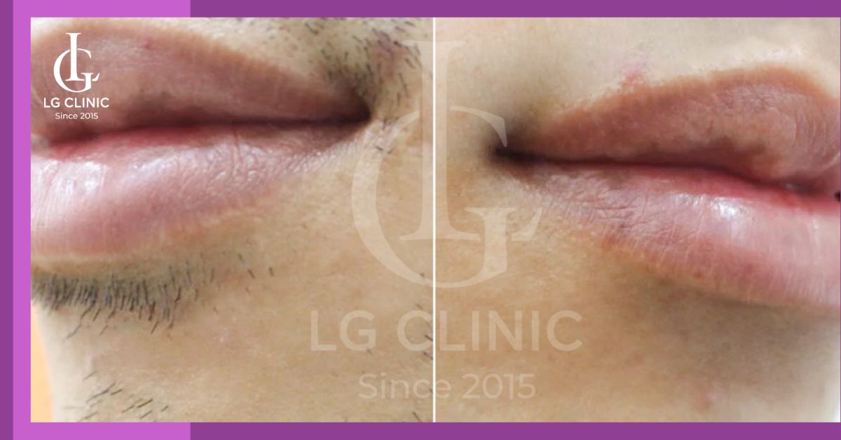 triet-long-mat-nam-voi-hieu-qua-toi-uu Triệt lông mặt nam với hiệu quả tối ưu