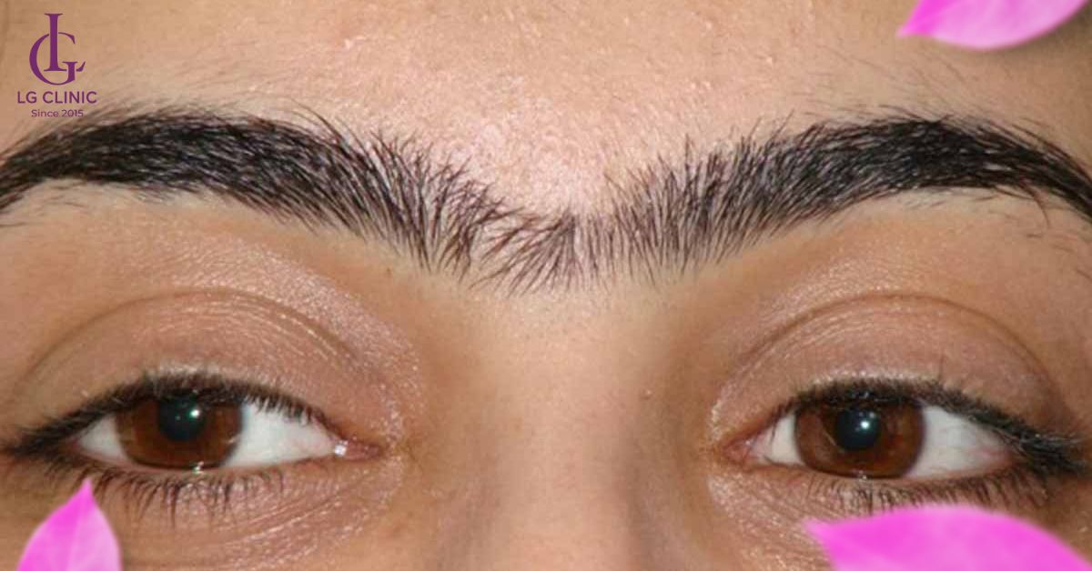 Triệt lông mày khi bị vấn đề chân mày giao nhau