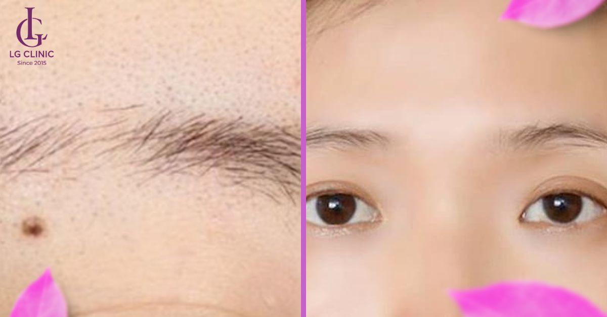 Triệt lông mày khi không rõ đường nét
