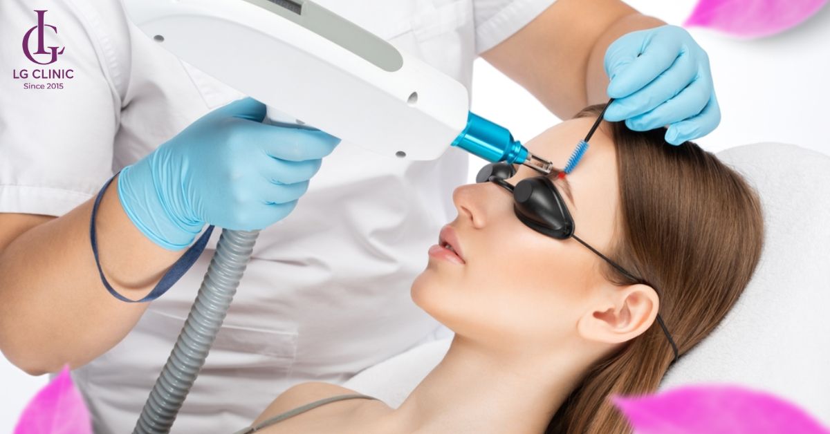 Triệt lông mày thừa để loại bỏ khu vực lông mọc lộn xộn trên chân mày