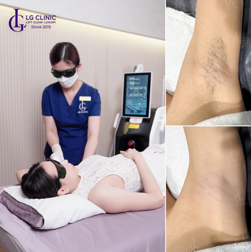 Cách triệt lông nách bằng vôi ăn trầu