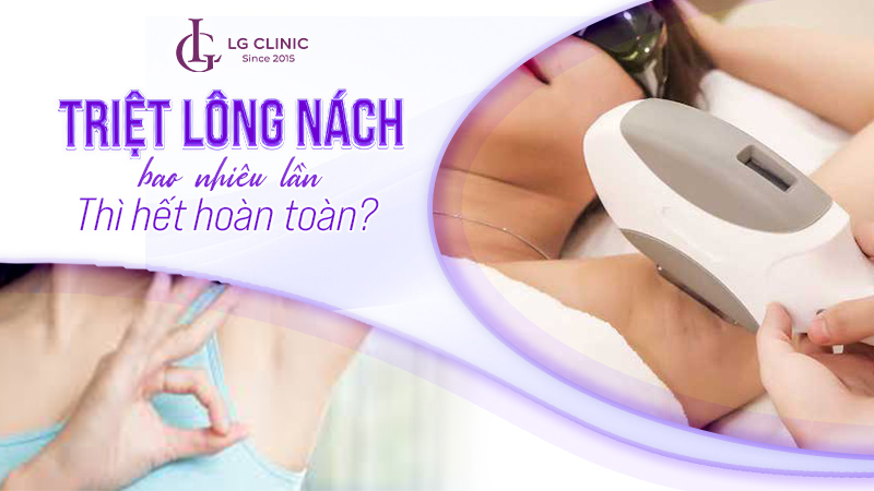 Triệt lông nách bao nhiêu lần thì hết