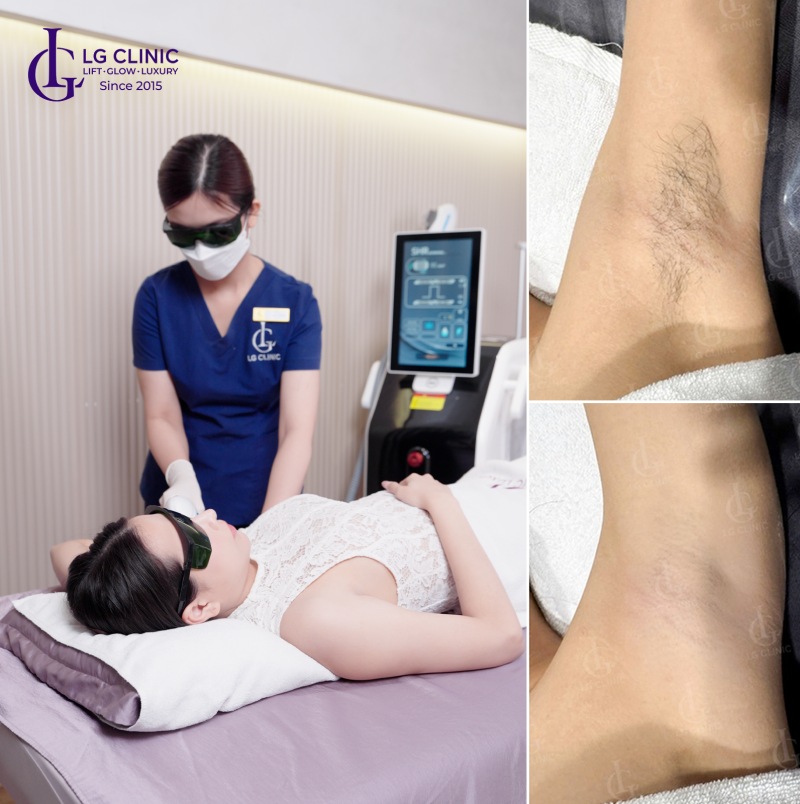 Sau khi triệt lông nách có được dùng lăn khử mùi không