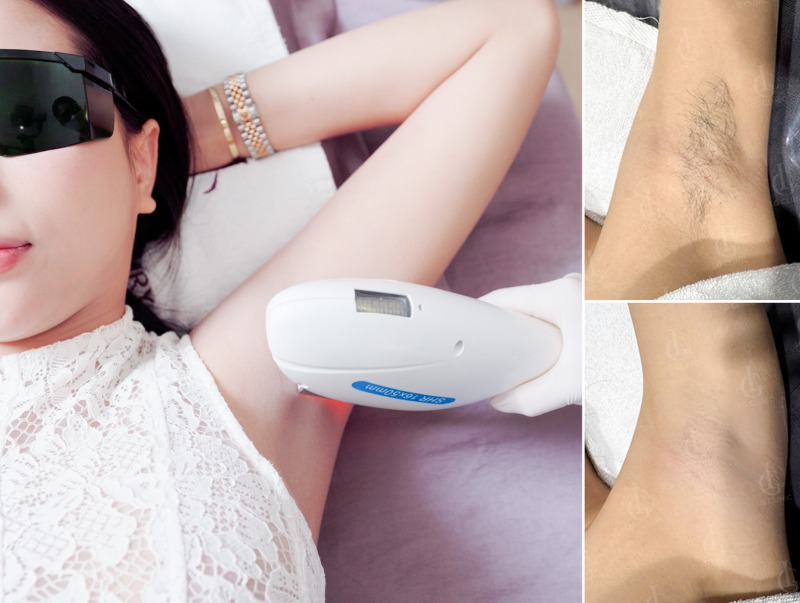Sau khi triệt lông nách có được dùng lăn khử mùi không