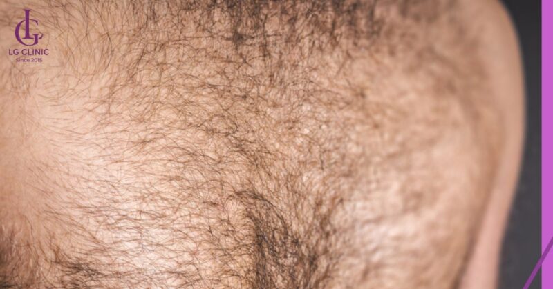 Lông vùng ngực nam giới gây mất thẩm mỹ khi diện các trang phục khoe cơ thể