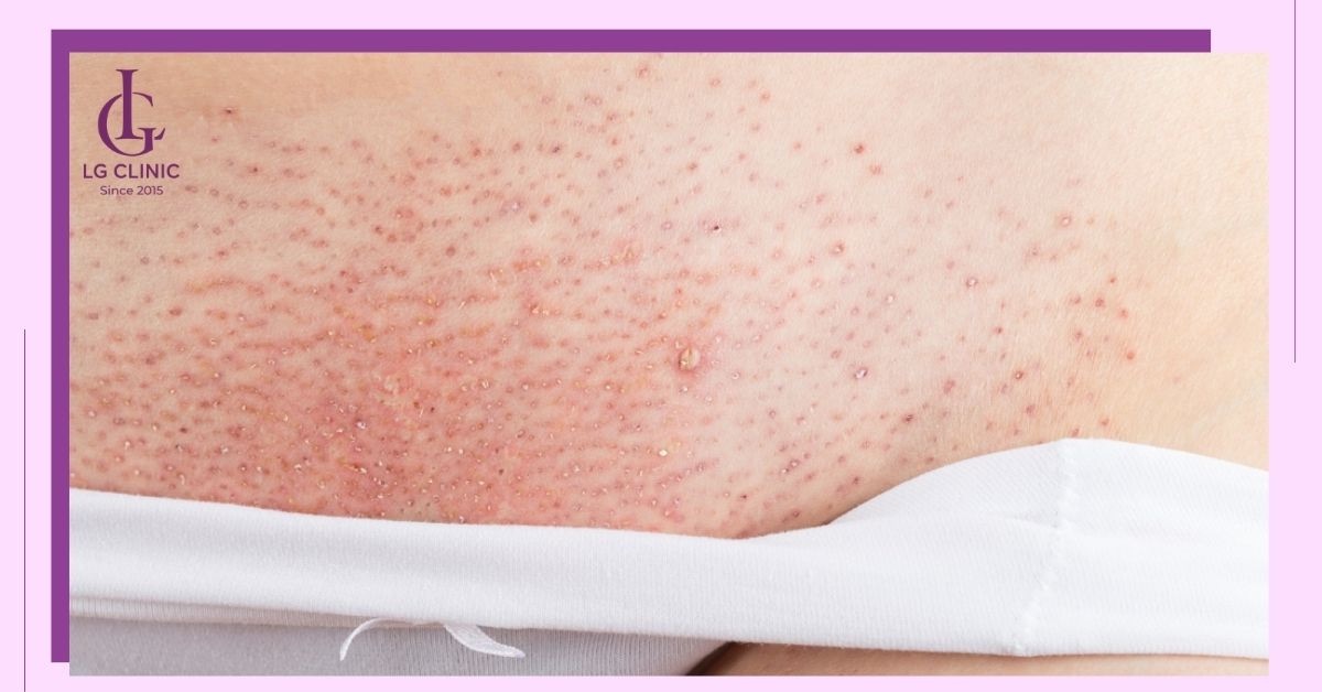 rủi ro khi triệt lông vùng kín