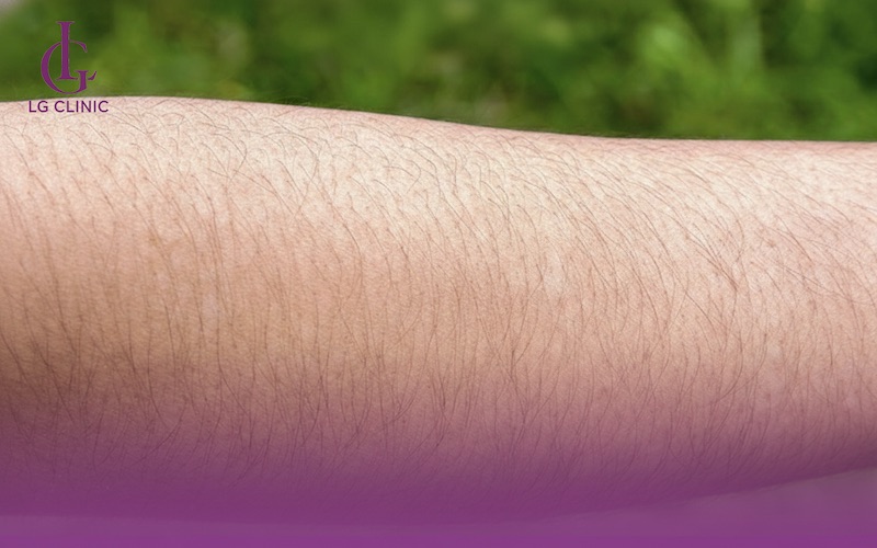 Lông tay dài, xoăn và rậm rạp