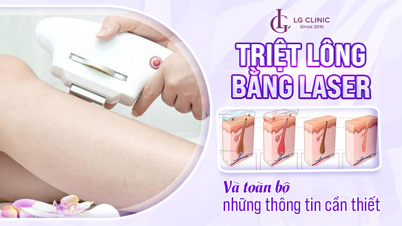 Triệt lông bằng laser