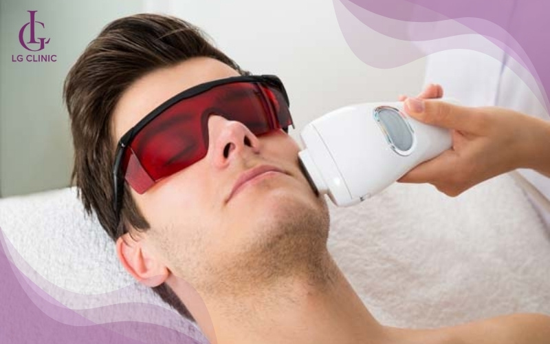 Triệt râu quai nón bằng laser mang lại hiệu quả lâu dài