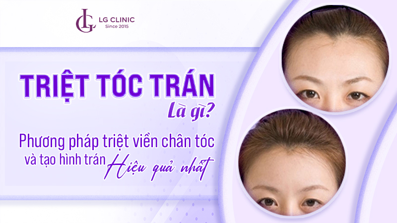 Triệt tóc trán