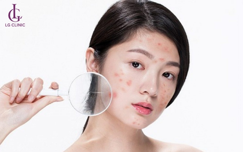 Làn da tuổi dậy thì dễ hình thành mụn thâm