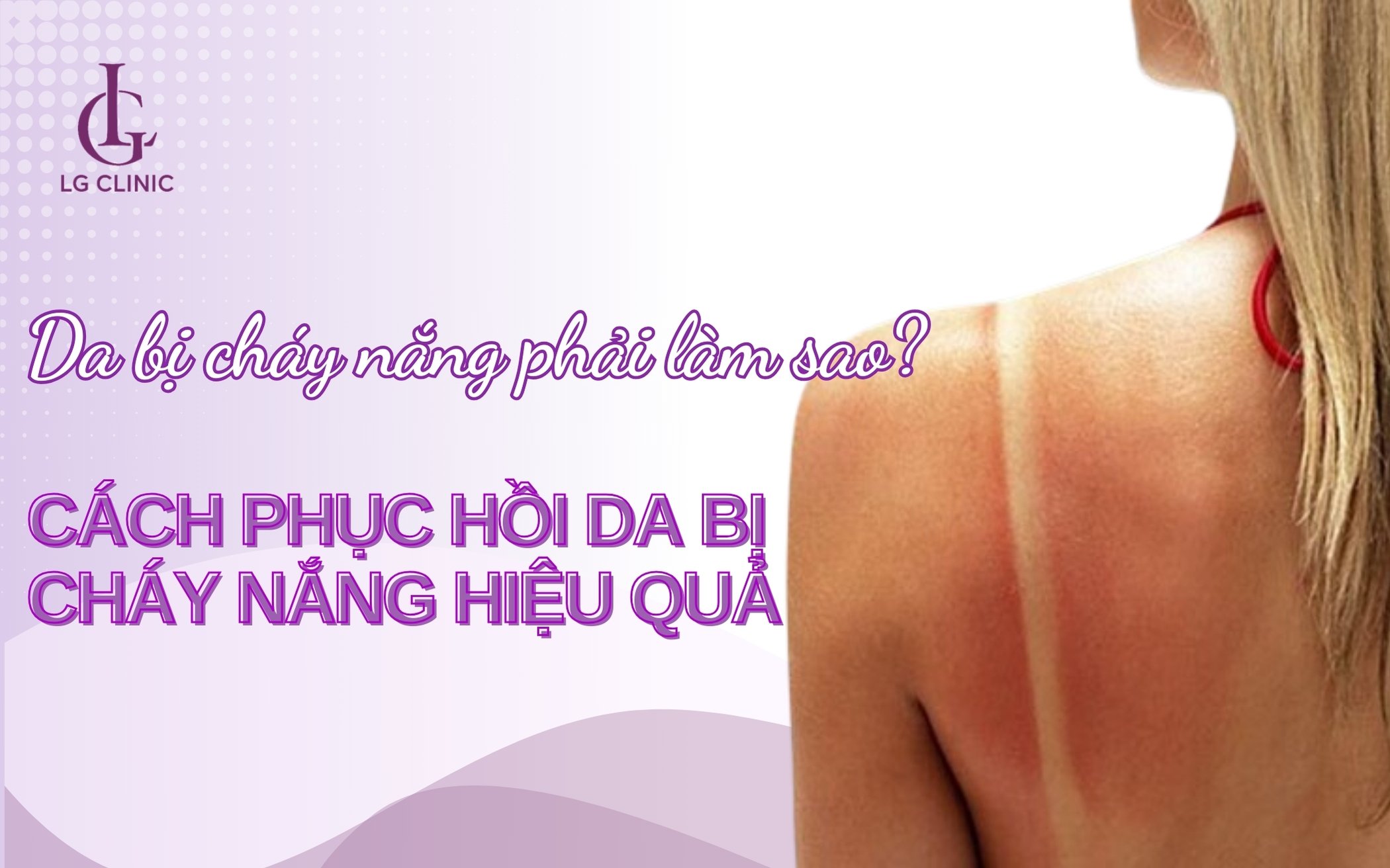 Cách phục hồi da bị cháy nắng nhanh nhất