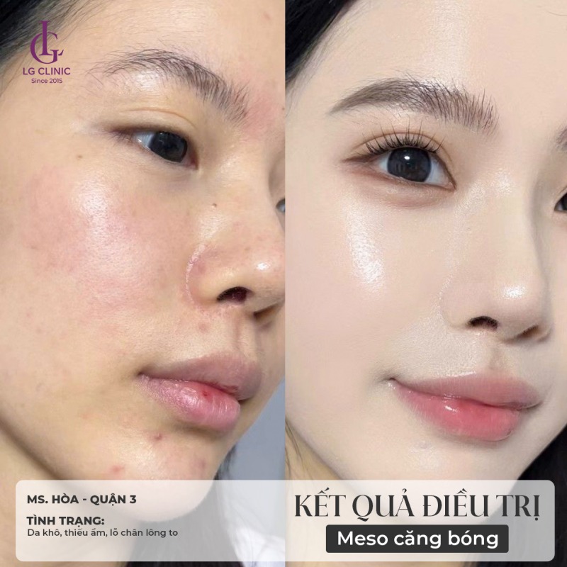 Có nên cấy trắng da mặt không