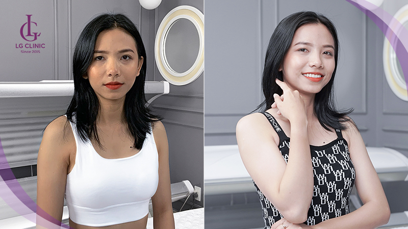 Kết quả liệu trình tắm trắng của khách hàng tại LG Clinic