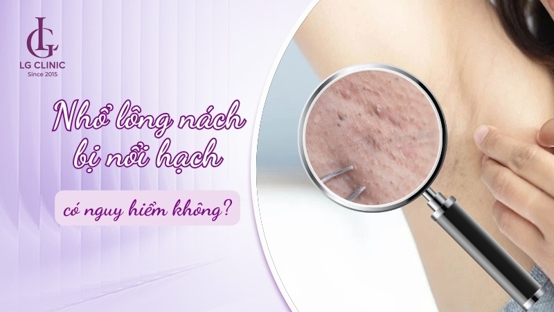 nhổ lông nách bị nổi hạch