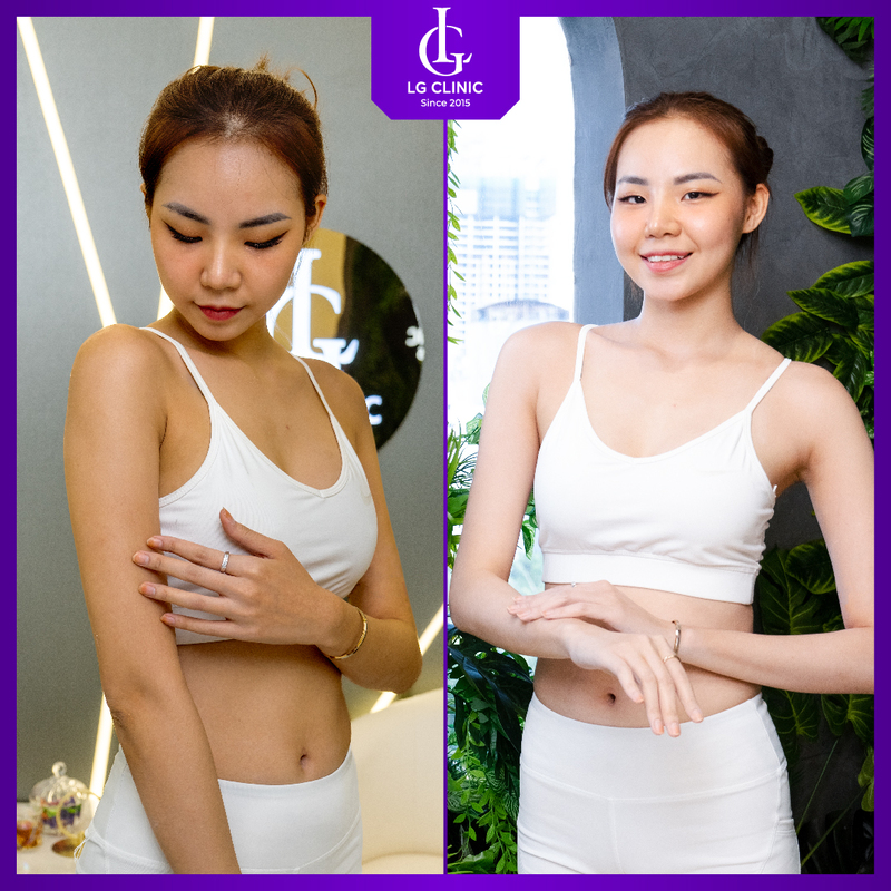 Da bật 3 tone sau khi hoàn thành liệu trình tắm trắng phi thuyền