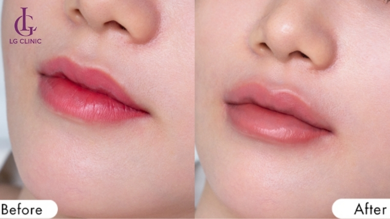 Xóa xăm môi là giải pháp khắc phục vấn đề xăm môi bị hỏng, không ưng ý