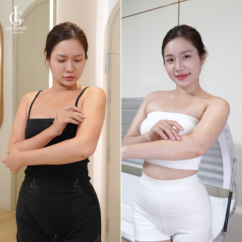 Cách làm chân trắng để mặc váy