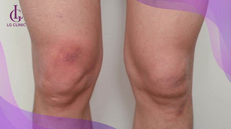 Có rất nhiều yếu tố dẫn đến tình trạng thâm khuỷu tay và đầu gối