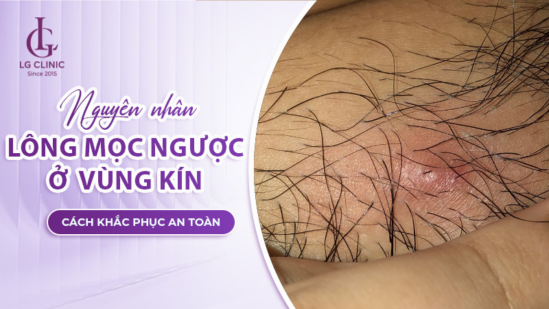 Lông mọc ngược ở vùng kín