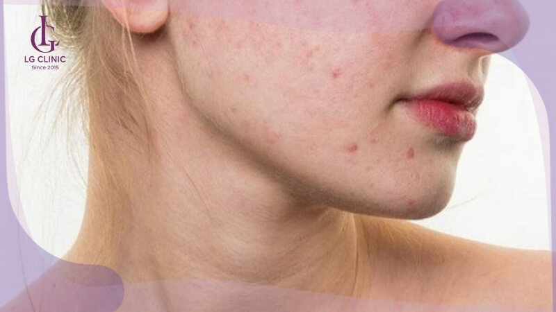 tác hại của kem trộn gây kích ứng da