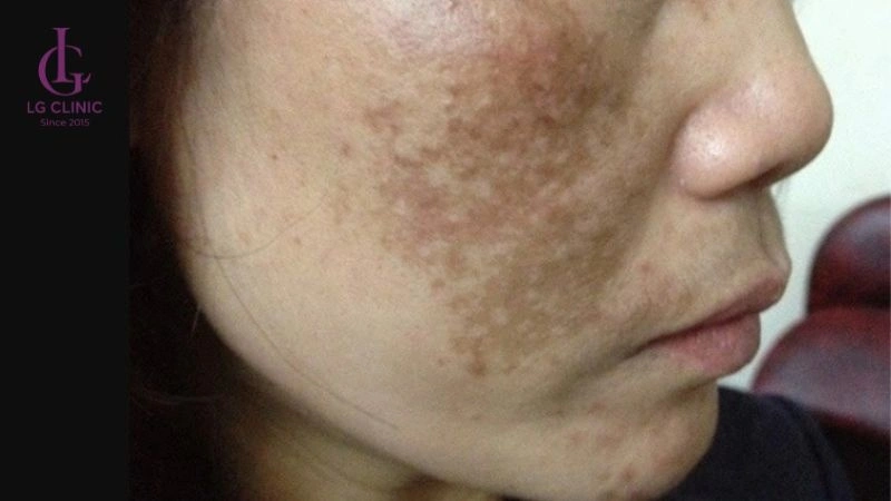 ảnh hưởng tăng sắc tố khi trị thâm bằng laser