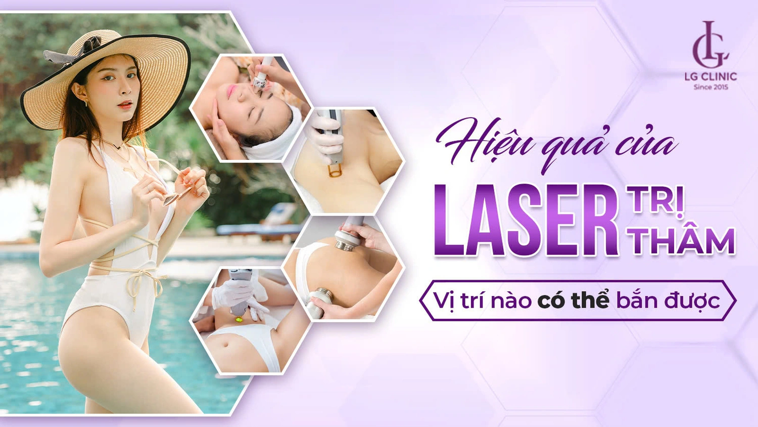 bắn laser để trị thâm