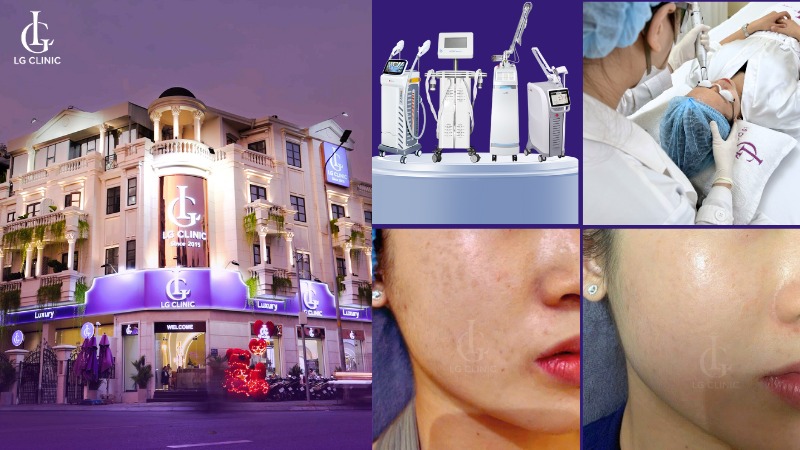 Laser trị thâm