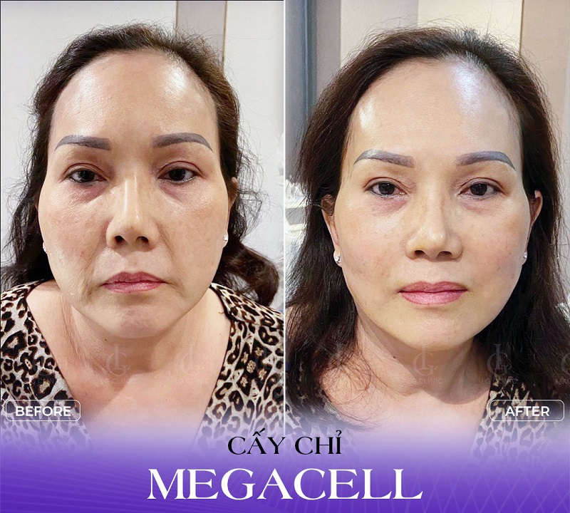 liệu trình căng chỉ Megacell