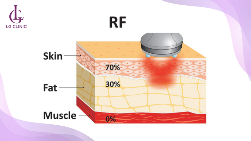 Sóng RF tác động sâu vào lớp trung bì dưới da