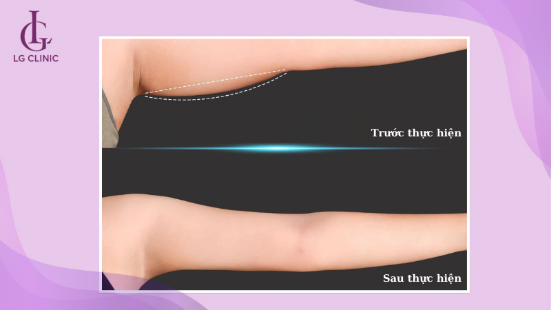 Sóng RF có thể áp dụng trên vùng da mỡ dưới cánh tay