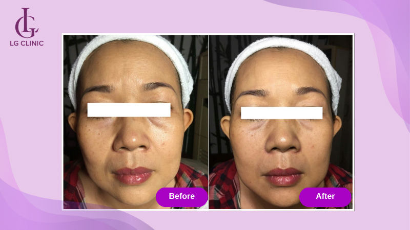 Khách hàng sau khi thực hiện công nghệ nâng cơ RF tại LG CLinic