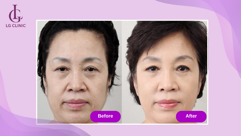 Da đàn hồi săn sau khi hoàn thành liệu trình 3 buổi nâng cơ bằng công nghệ RF