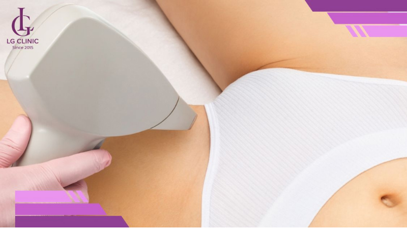 Triệt lông bikini bằng tia Laser