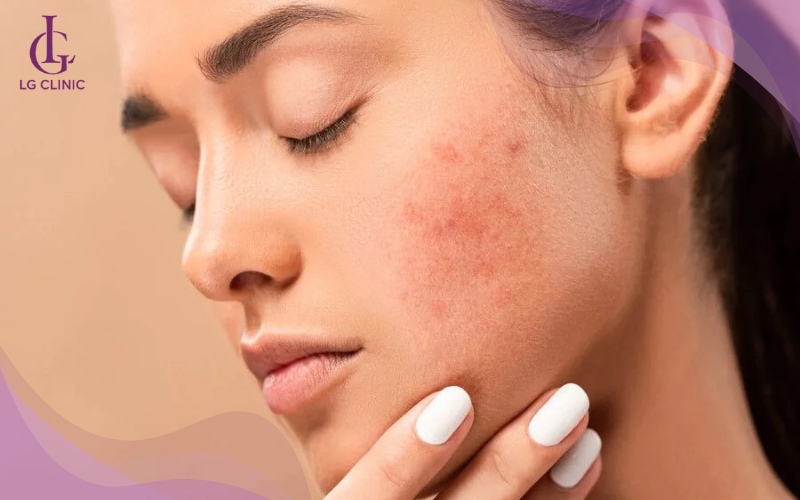 Da mặt bị cháy nắng có triệu chứng đỏ rát, phồng rộp