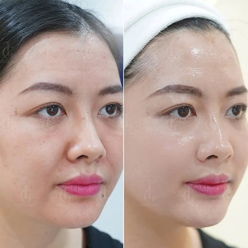 Da mặt bị cháy nắng làm sao để trắng lại