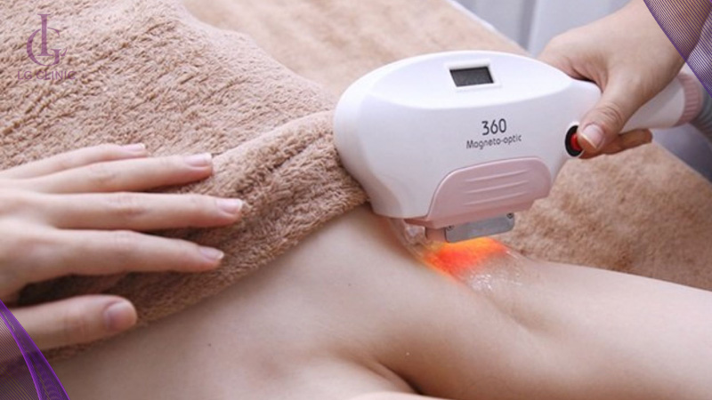 Triệt lông vĩnh viễn vùng nách khi đến tháng