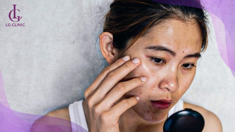 Da mặt đen sạm do bị cháy nắng sau 3 ngày