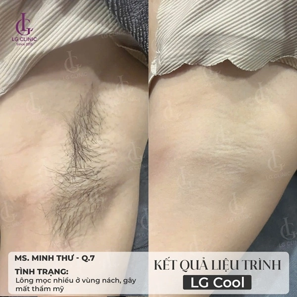 hình ảnh kết quả trước và sau khi triệt lông nách tại LG Clinic