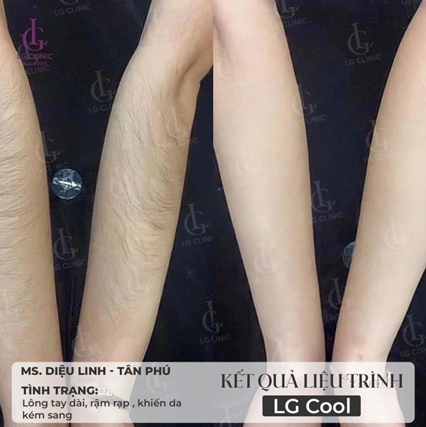 hình ảnh kết quả trước và sau khi triệt lông tay LG Clinic