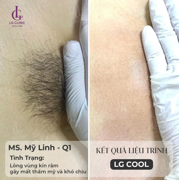 hình ảnh trước và sau khi triệt lông bikini tại LG Clinic