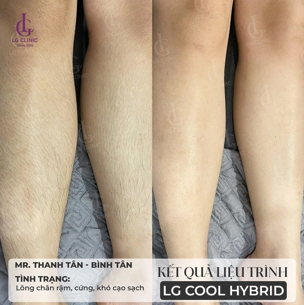 hình ảnh kết quả trước và sau khi triệt lông chân tại LG Clinic