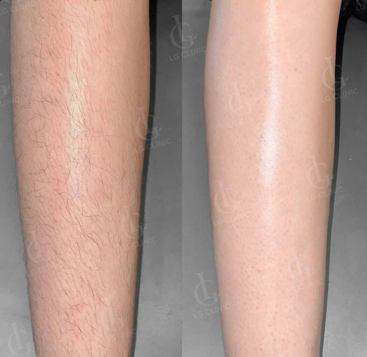 hình ảnh trước và sau khi triệt lông chân tại LG Clinic