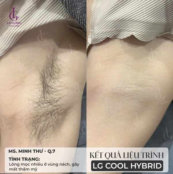 hình ảnh kết quả trước và sau khi triệt lông nách tại LG Clinic