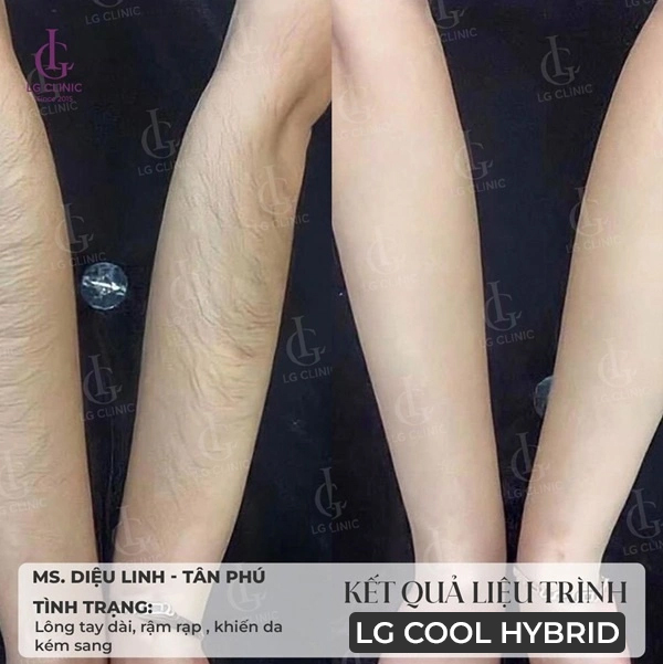 hình ảnh trước sau khi triệt lông tay tại lg clinic