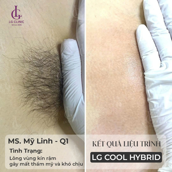 hình ảnh trước và sau khi triệt lông bikini tại LG Clinic