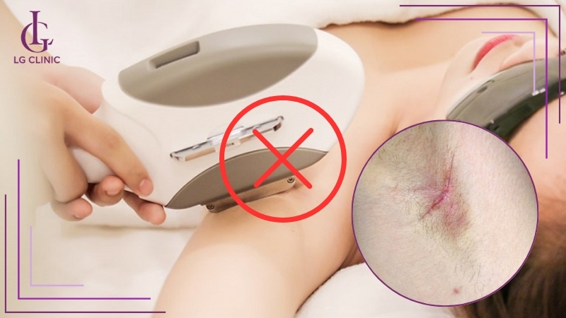 Cẩn trọng khi triệt lông nếu da yếu hoặc chưa rõ có nên cạo lông trước khi triệt lông.
