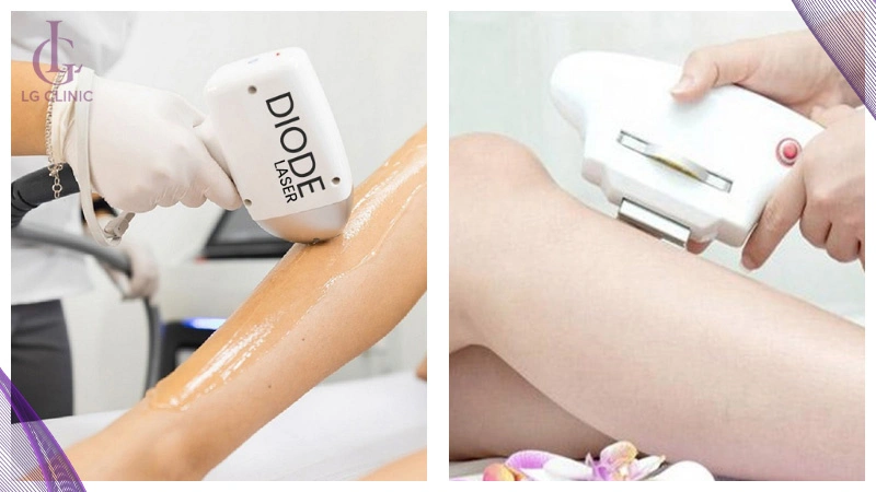 Triệt lông có cần bôi gel không trong từng bước quy trình?