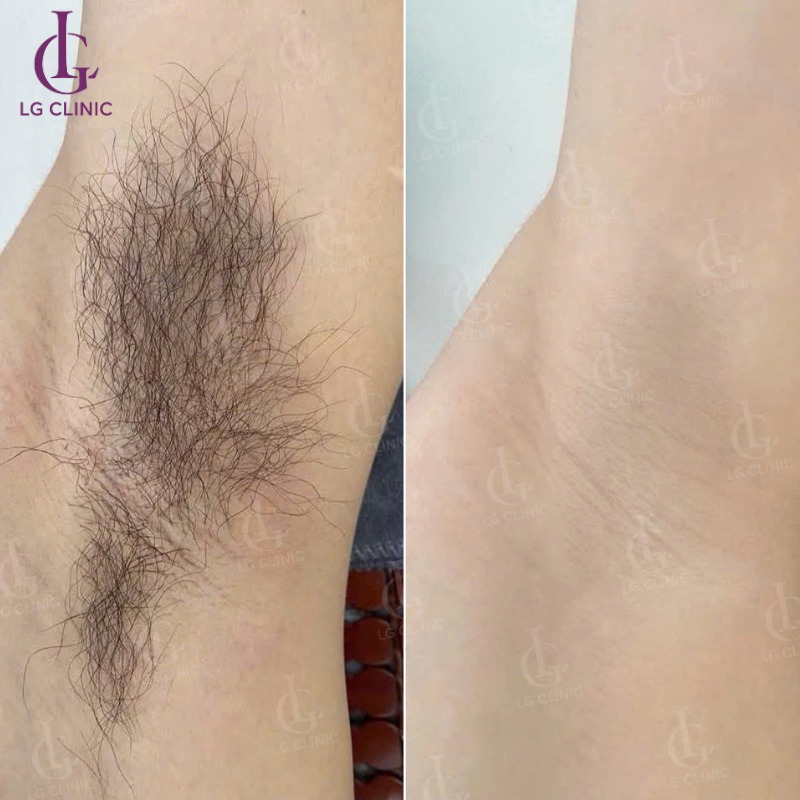 cách triệt lông nách bằng trứng gà