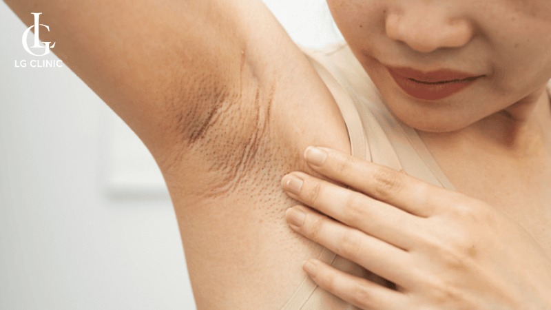 Wax lông nách có bị thâm không